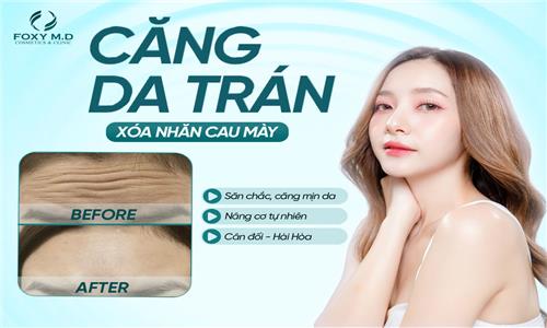 Căng da trán xóa nhăn cau mày – Feedback thực tế với căng chỉ collagen & botox