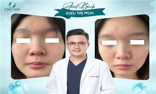 Feedback điều trị mụn – Chia sẻ thật lòng từ trải nghiệm thực tế