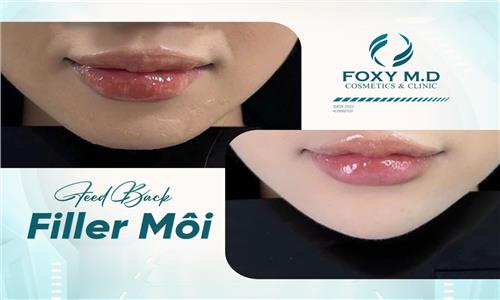 Feedback filler môi: Review thực tế & Bí quyết để có đôi môi đẹp tự nhiên