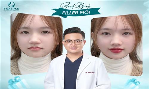 Feedback filler môi: Review thực tế & Kinh nghiệm để có đôi môi đẹp tự nhiên