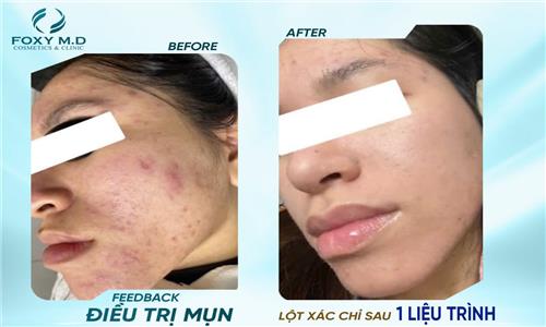 Feedback điều trị mụn – Bí quyết da sạch mụn, sáng khỏe