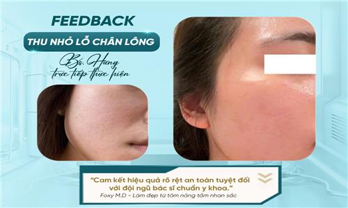 Feedback thu nhỏ lỗ chân lông – Hành trình da mịn mượt từ trải nghiệm thực tế