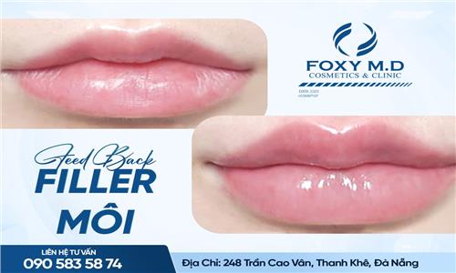 Feedback filler môi – Chia sẻ trải nghiệm thật và bí quyết chọn dịch vụ tốt