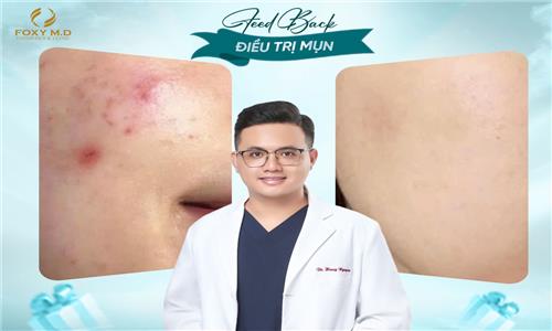 Feedback Điều Trị Mụn – Chia Sẻ Thực Tế & Hiệu Quả Bất Ngờ
