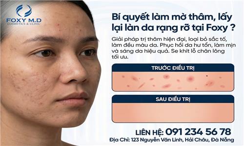 Bí quyết làm mờ thâm lấy làn da rạng rỡ tại Foxy là gì?