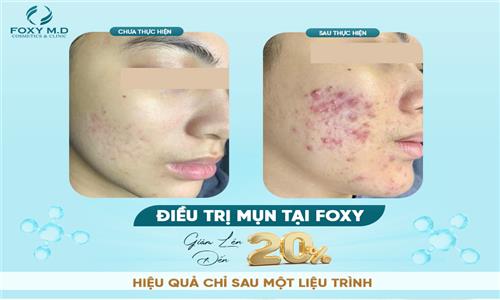Feedback điều trị mụn – Chia sẻ thật, kết quả thật