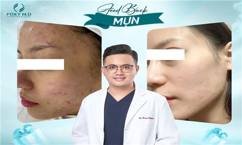 Feedback mụn – Trải nghiệm thực tế giúp bạn chọn đúng cách trị mụn