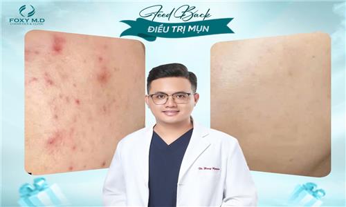 Feedback trị mụn – Lời kể thật từ khách hàng thật