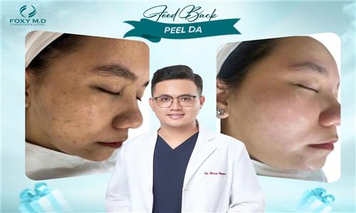 Feedback peel da – Chia sẻ thật, kết quả thật