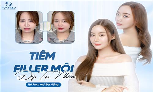 Tiêm Filler Môi Đẹp Tự Nhiên Có Khó Không? Bật Mí Công Nghệ Độc Quyền!