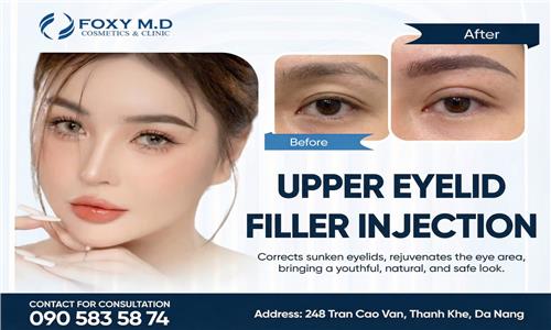 Upper eyelid filler injections: A natural solution for eye area rejuvenation.