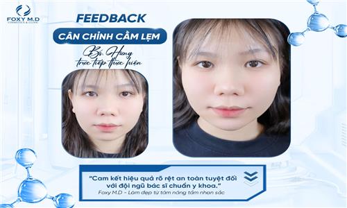 Feedback cân chỉnh cằm lẹm – Review chân thực từ khách hàng