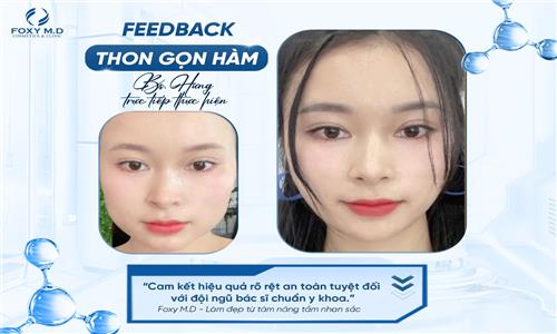 Feedback thon gọn hàm – Bí quyết sở hữu gương mặt V-line tự nhiên
