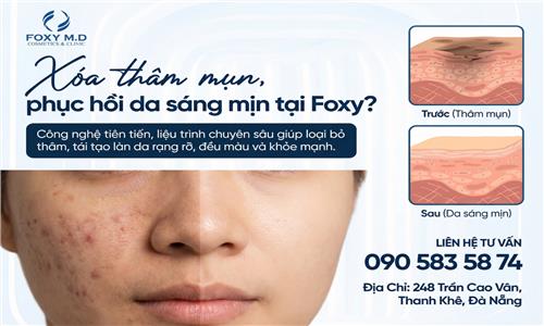 Xóa thâm mụn phục hồi da sáng mịn tại Foxy là gì?