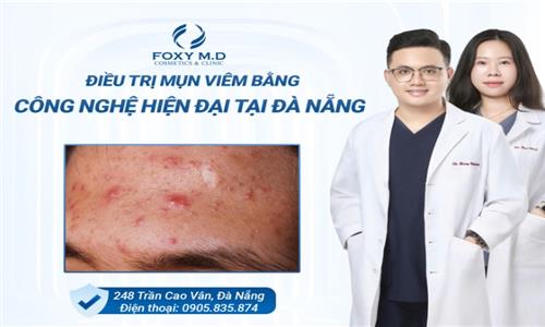 ĐIỀU TRỊ MỤN VIÊM BẰNG CÔNG NGHỆ HIỆN ĐẠI TẠI ĐÀ NẴNG