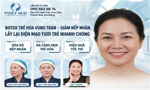 Botox trẻ hóa vùng trán – giảm nếp nhăn lấy lại diện mạo tươi trẻ nhanh chóng