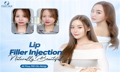 Is Getting Natural-Looking Lip Fillers Difficult? Discover Our Exclusive Technology