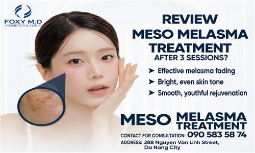 Review of Meso Treatment for Melasma After 3 Sessions: Real Results and What You Need to Know