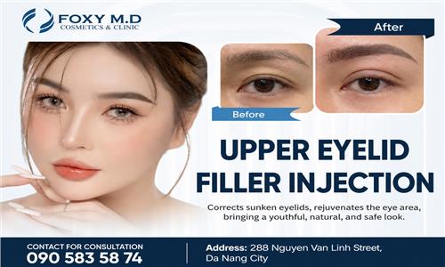 Upper eyelid filler injections: A natural solution for eye area rejuvenation.