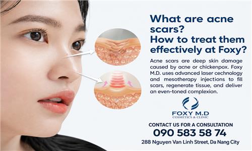 What are pitted scars and how to treat them permanently at Foxy?