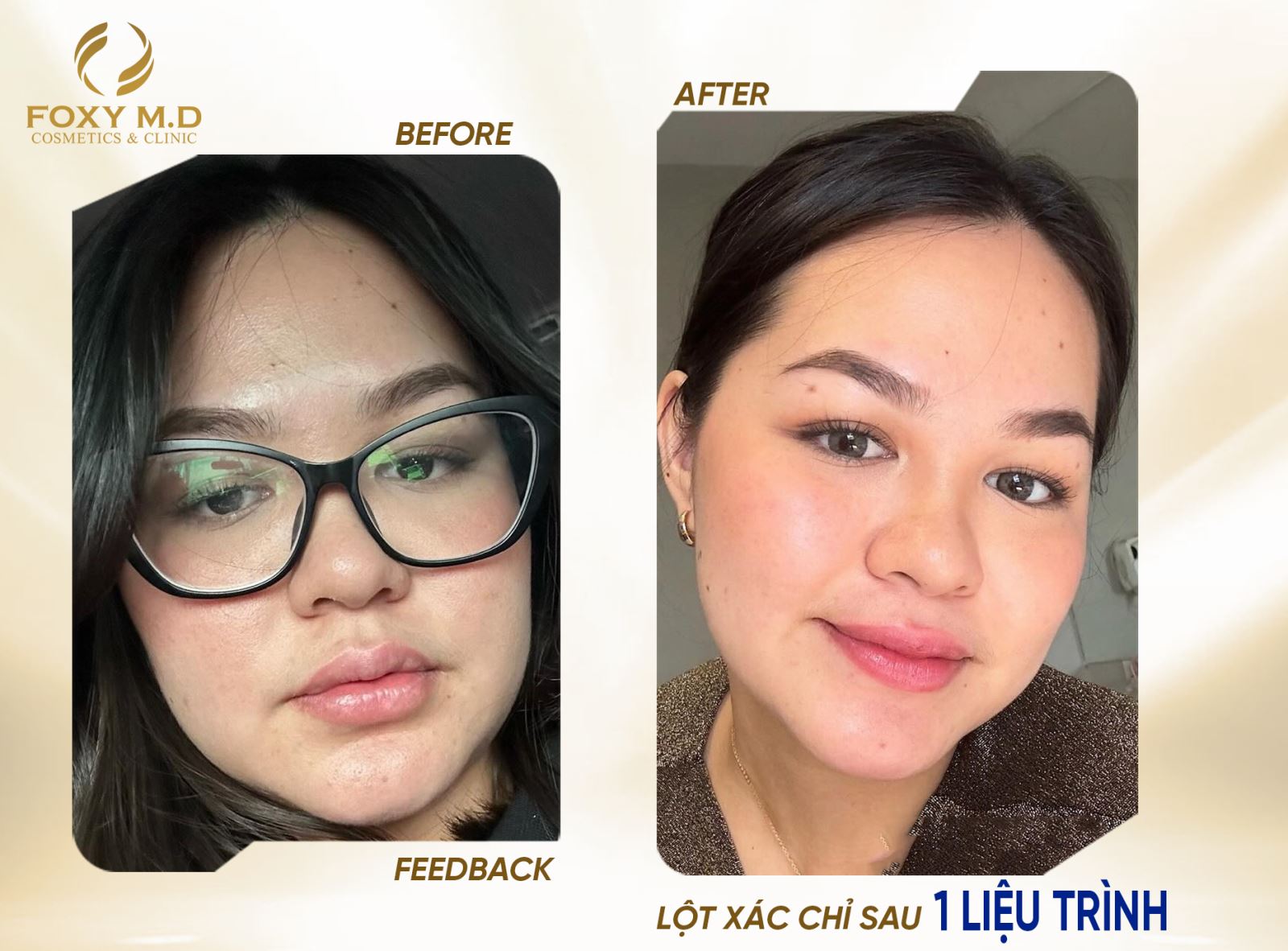 Filler Fullface tại Foxy: Trẻ hóa toàn diện, đẹp tự nhiên