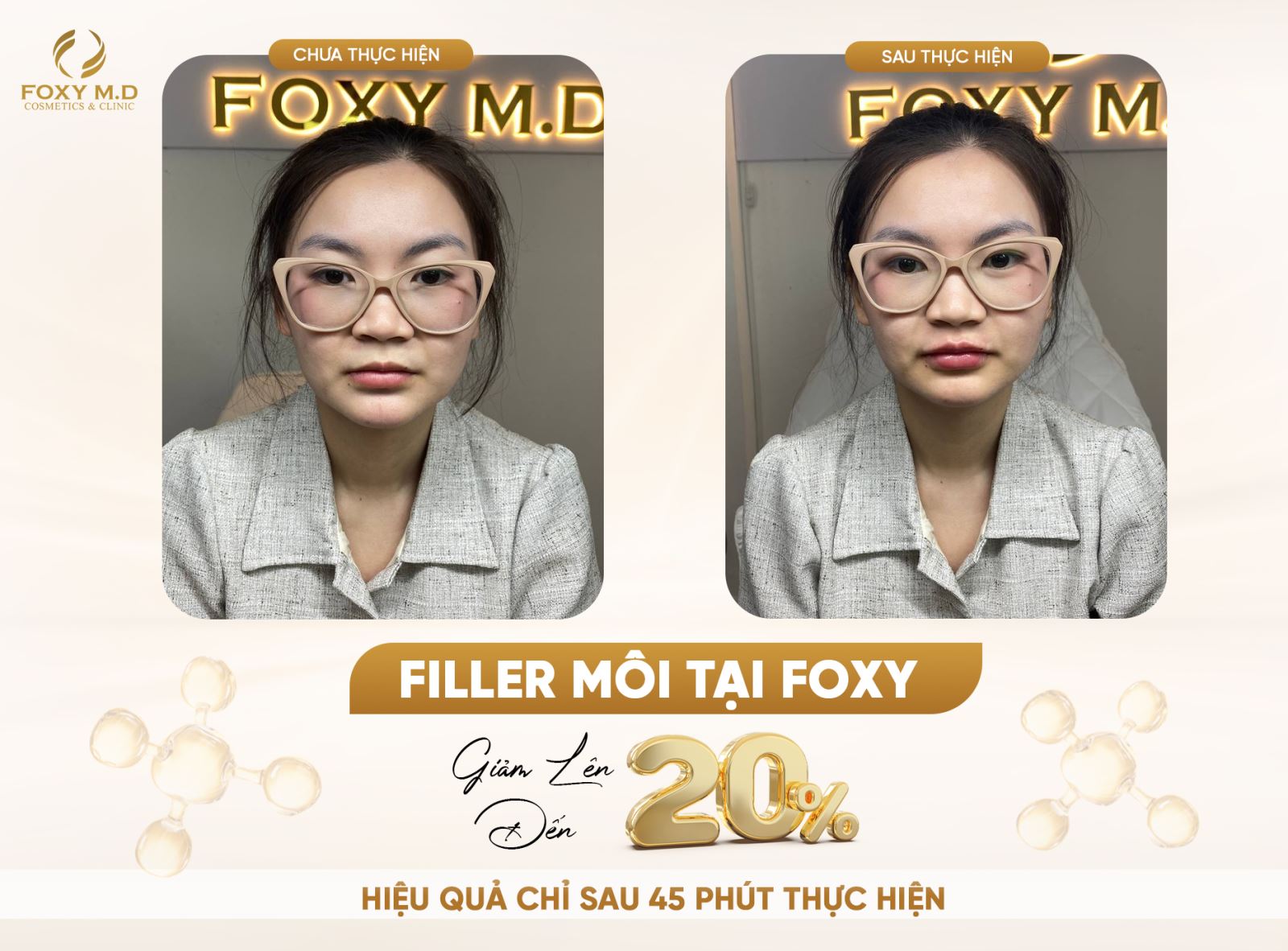 Filler môi tại Foxy – Căng mọng tự nhiên, không đau, đẹp chuẩn hotgirl