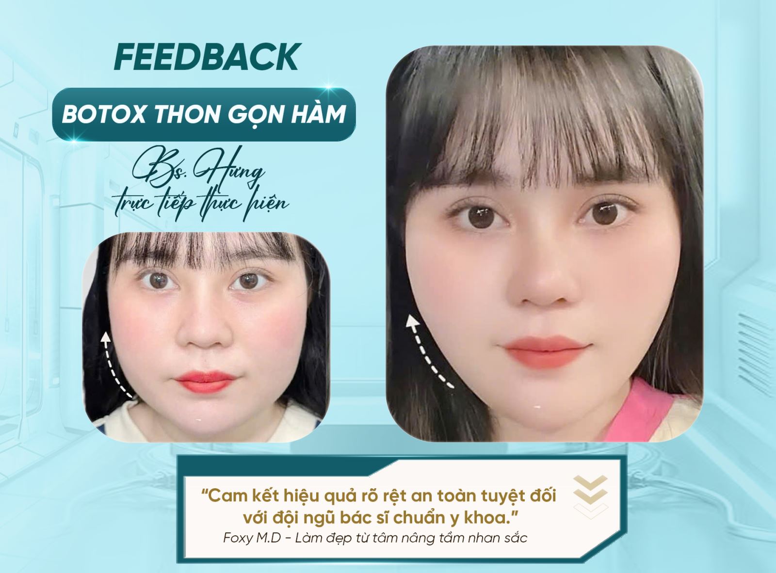 Botox thon gọn hàm: Giải pháp an toàn để sở hữu gương mặt V-line tự nhiên