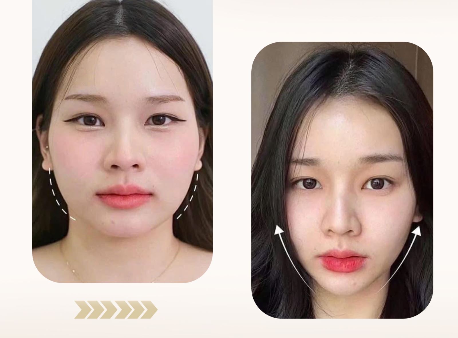 Tiêm filler tại Foxy – Gương mặt hài hòa, đẹp tự nhiên, không phẫu thuật