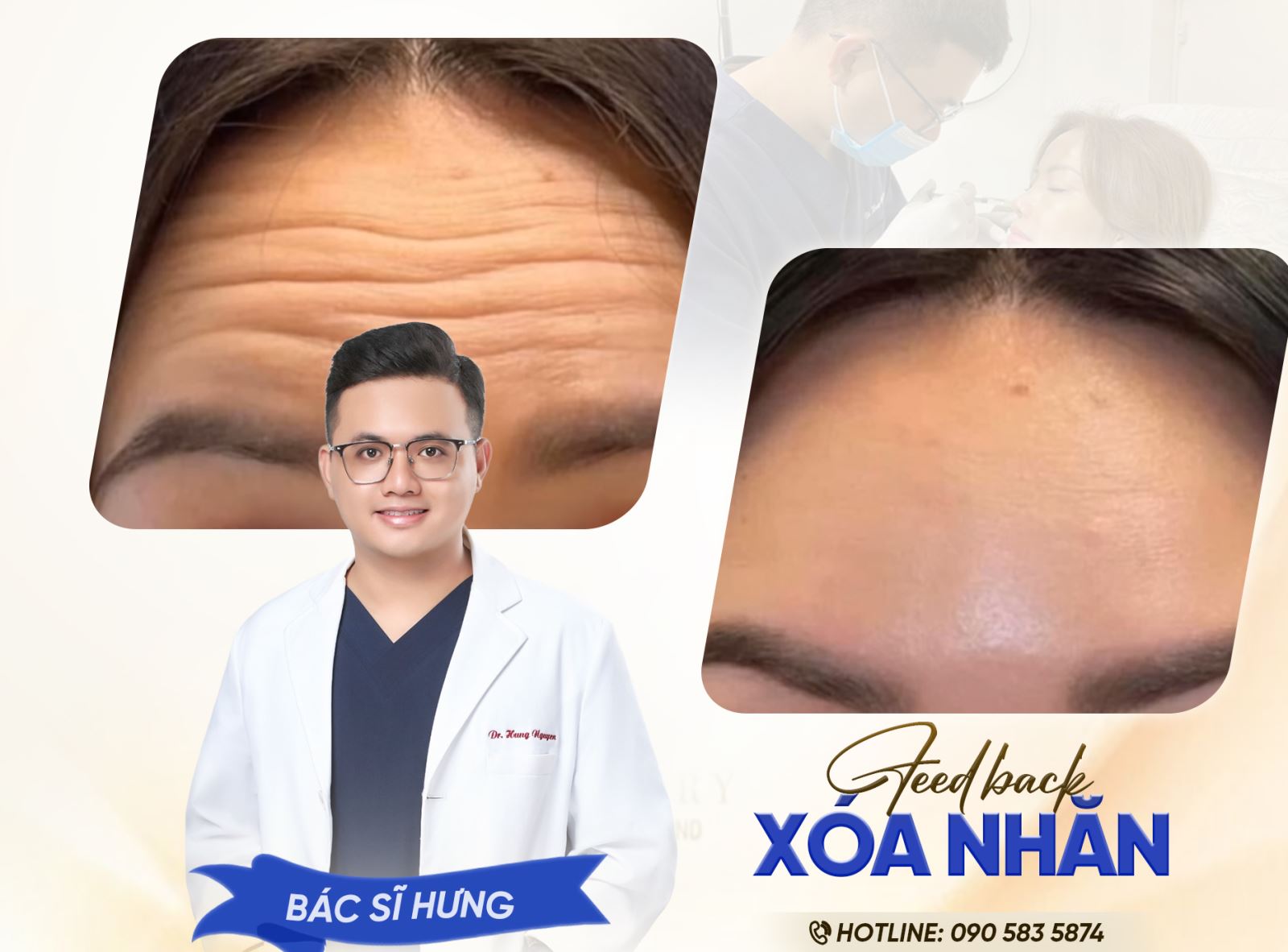 Xóa nhăn không đau, không sưng – Làn da trẻ lại ngay tại Foxy