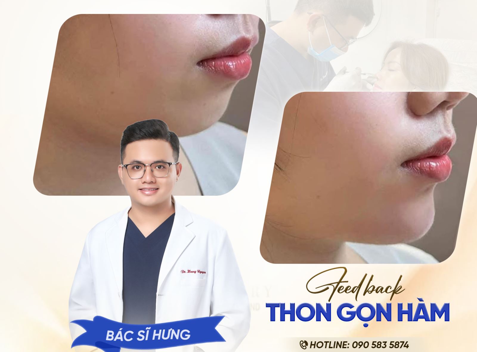 Thon gọn hàm tại Foxy – Mặt V-line không dao kéo, hiệu quả nhanh chóng
