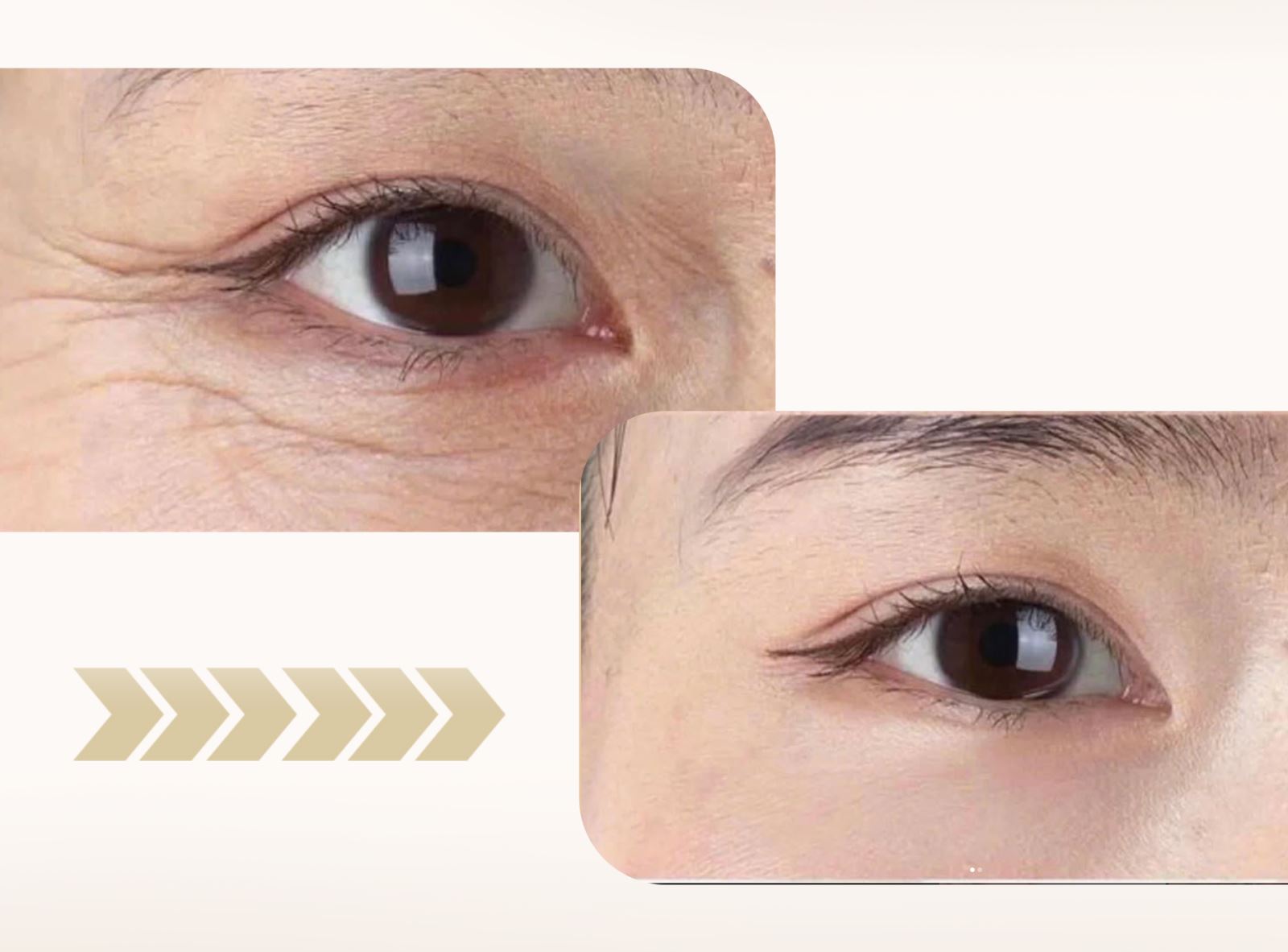 Xóa nhăn mắt Foxy – Trẻ hóa vùng mắt, lấy lại vẻ tươi tắn chỉ sau 15 phút