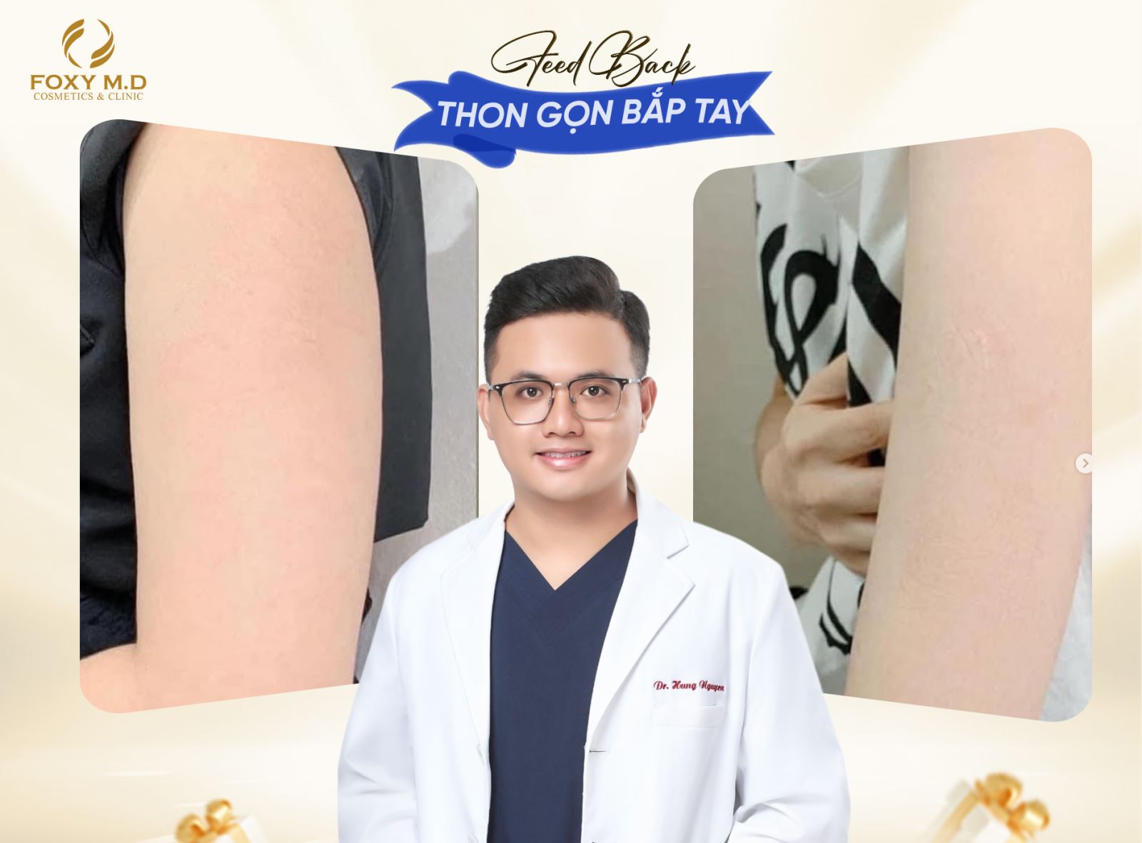 Thon gọn bắp tay tại Foxy – Giải pháp nhanh, không đau, dáng tay thon gọn như ý