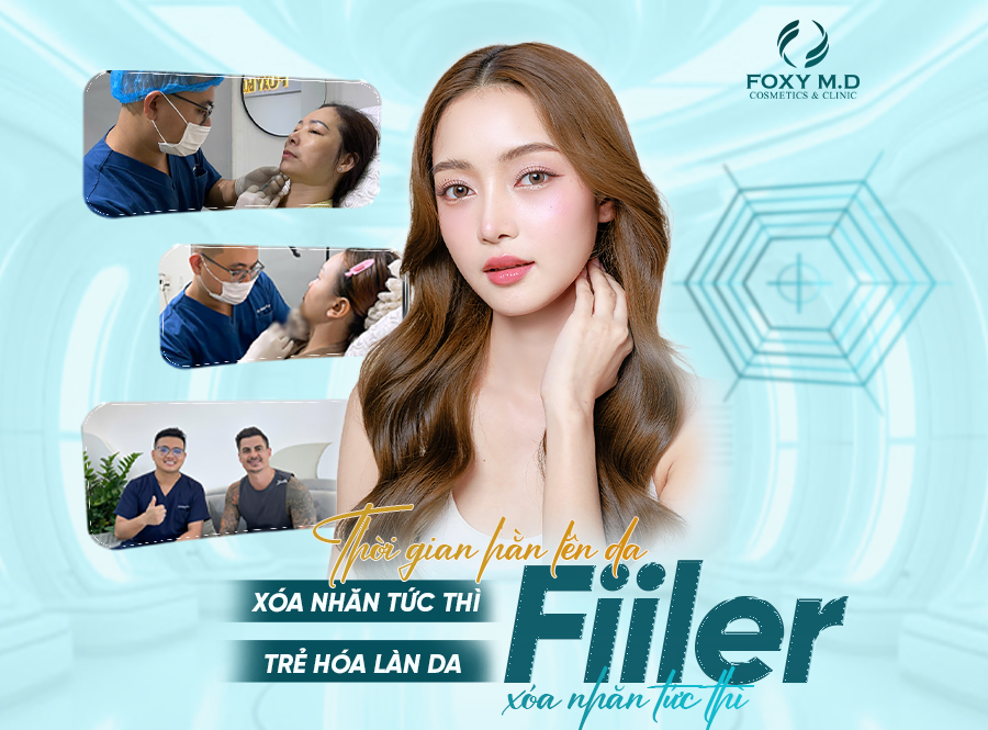 Filler xóa nhăn tức thì – Da căng mịn chỉ sau 30 phút 