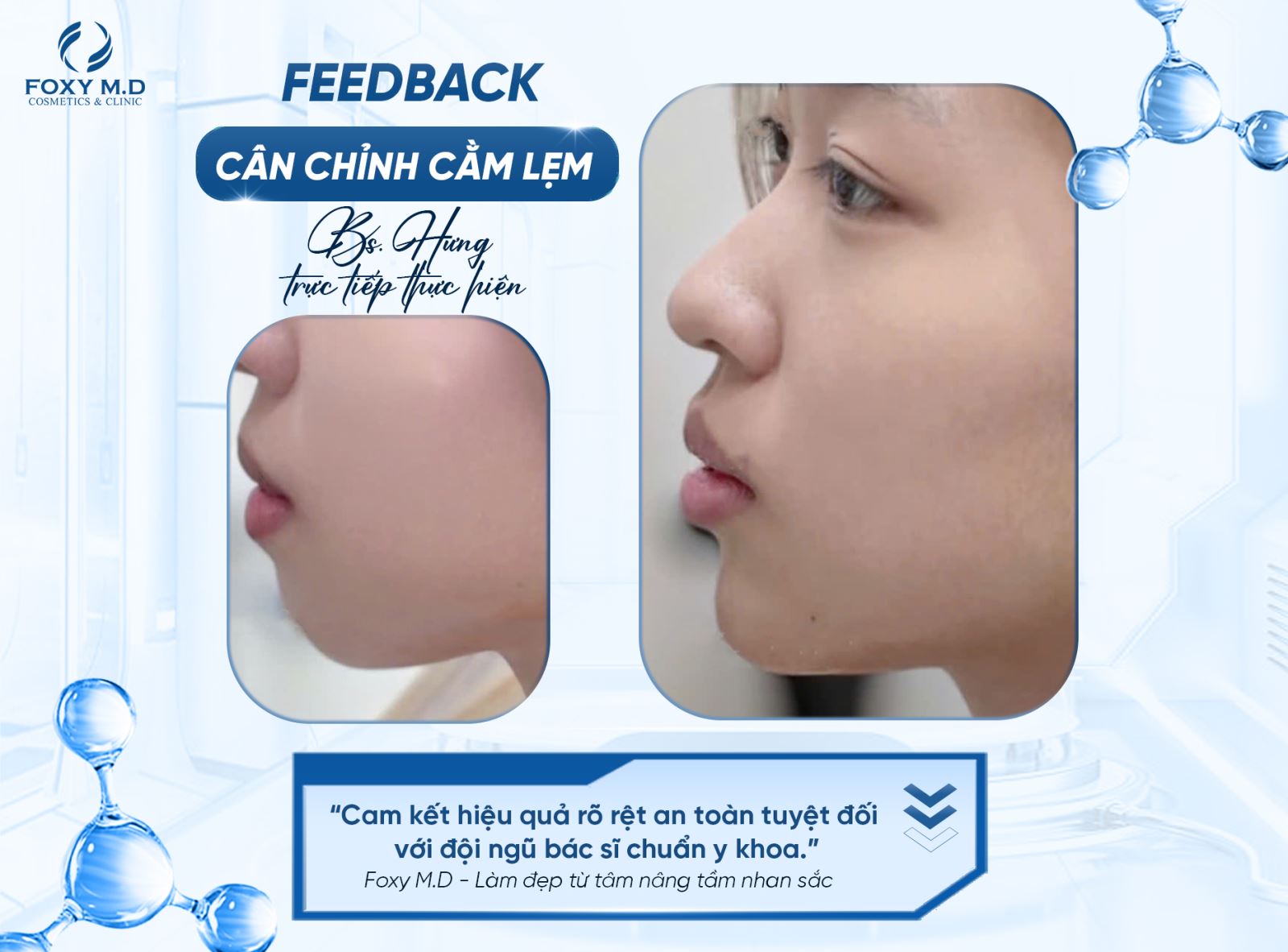 Cân chỉnh cằm lẹm – Giải pháp giúp gương mặt cân đối và tự tin