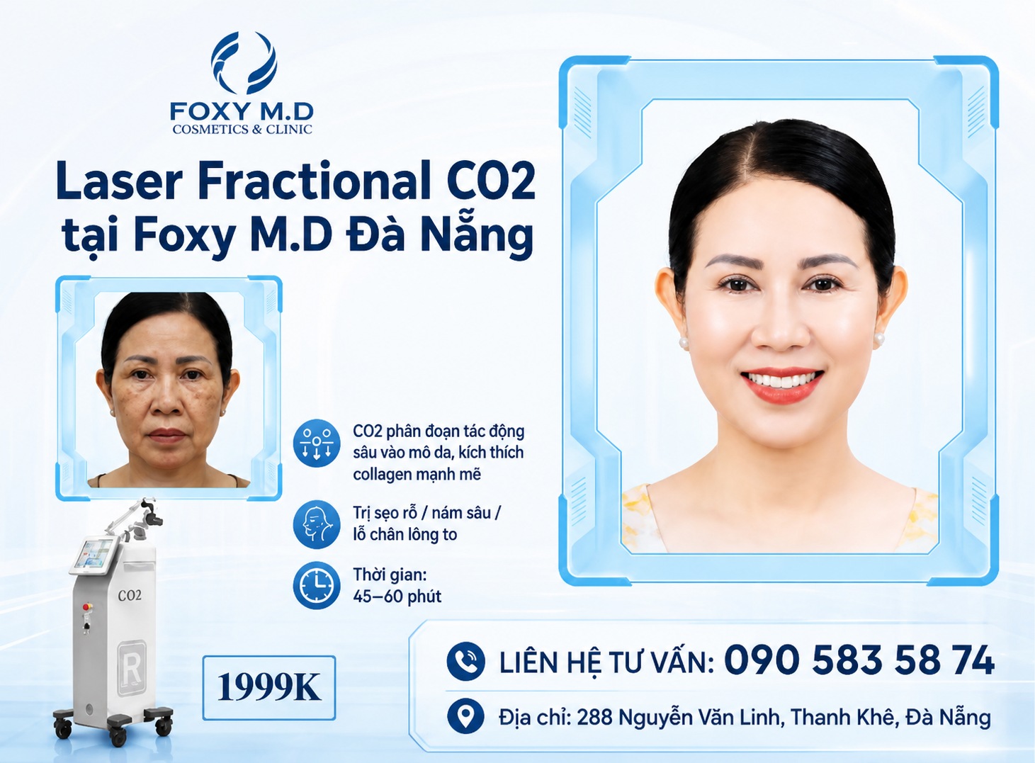 Laser CO2 Fractional Đà Nẵng — Điều Trị Sẹo Rỗ, Lỗ Chân Lông & Nếp Nhăn Chuyên Sâu Tại Foxy M.D Clinic