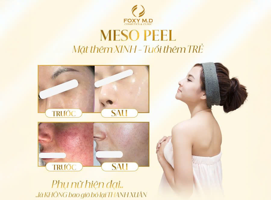 meso peel mặt thêm xinh- tuổi thêm trẻ